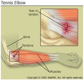 EPIKONDILITIS LATERAL (TENNIS ELBOW)